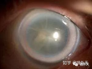 图片[3]-近视不可怕，可怕的是高度近视以后出现的并发症？-一鸣资源网