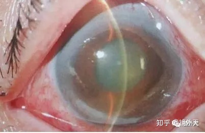 图片[2]-近视不可怕，可怕的是高度近视以后出现的并发症？-一鸣资源网