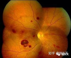 图片[6]-近视不可怕，可怕的是高度近视以后出现的并发症？-一鸣资源网