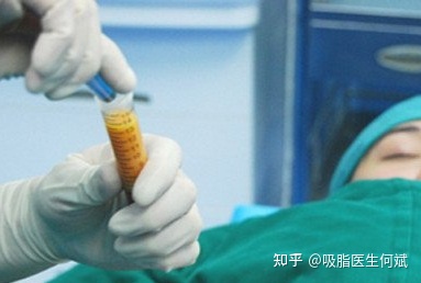 图片[2]-做吸脂/抽脂一般多少钱？价格如何？-一鸣资源网