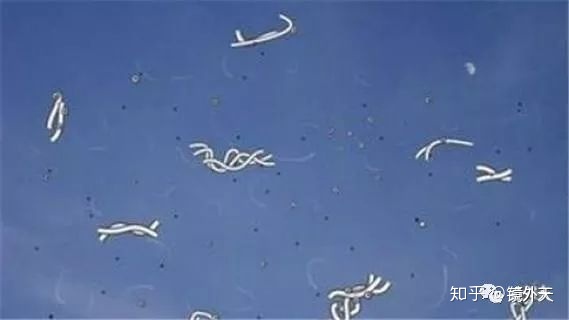 图片[4]-近视不可怕，可怕的是高度近视以后出现的并发症？-一鸣资源网