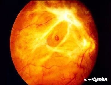 图片[1]-近视不可怕，可怕的是高度近视以后出现的并发症？-一鸣资源网